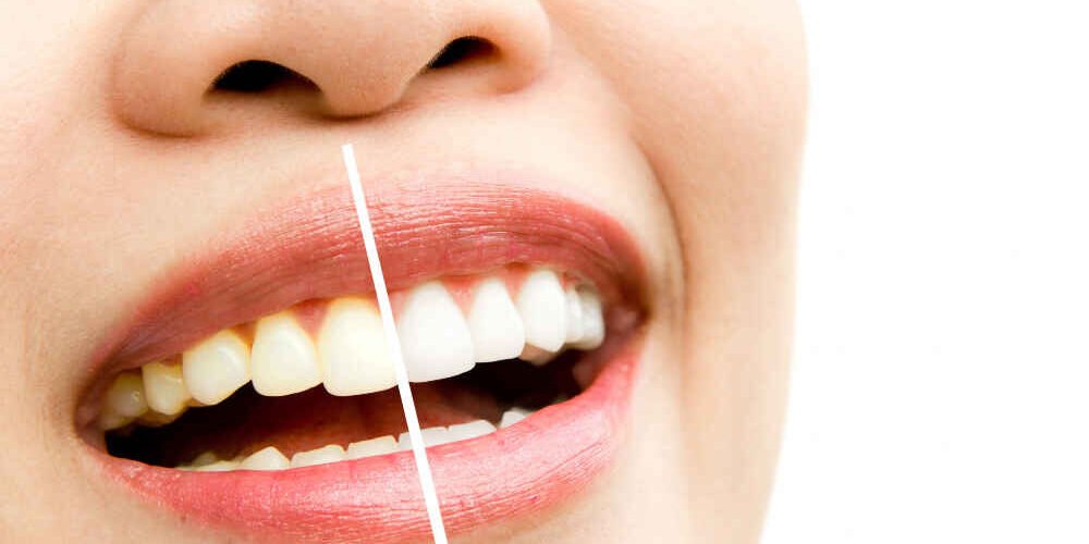 ¿El Café Mancha Los Dientes? ¿El Café Mancha Los Dientes?